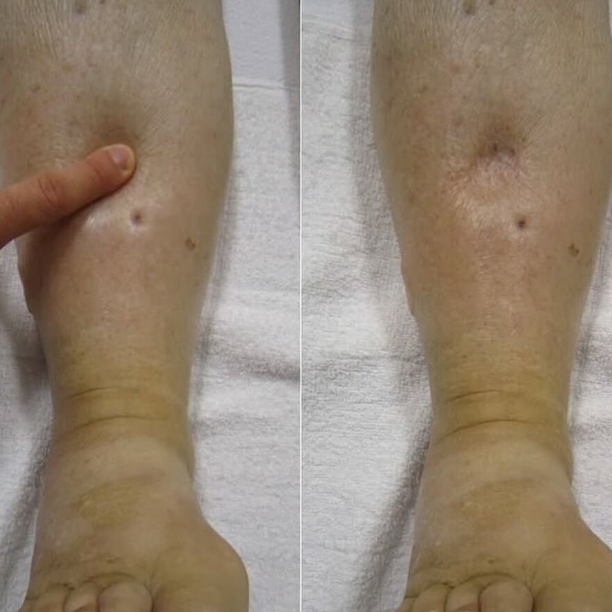 Close-up of a lower leg showing a small bizarre medical skin lesion with a finger pointing at it on white fabric background.