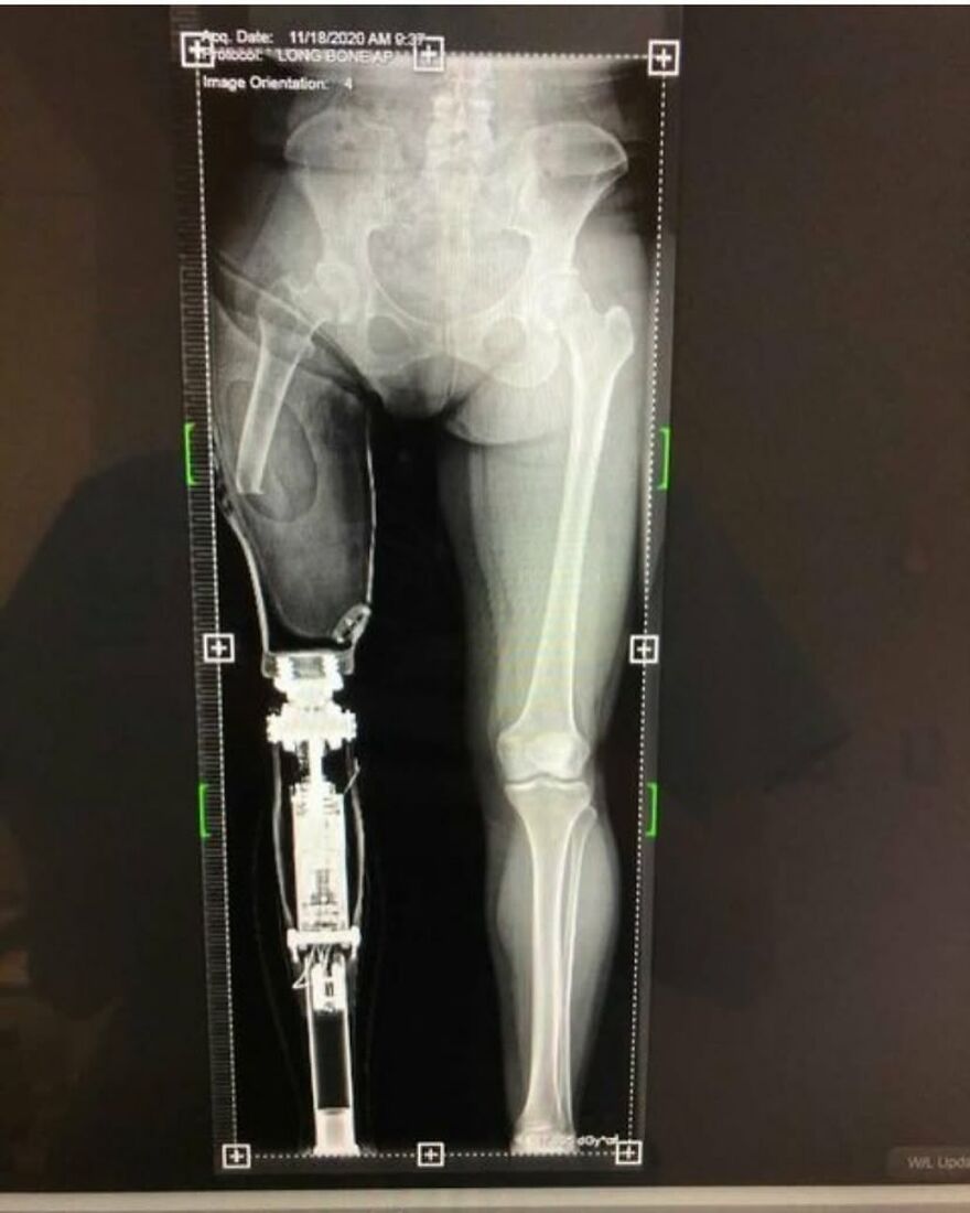 X-ray image showing a leg with a mechanical prosthetic implant next to a natural leg, part of bizarre medical pics.