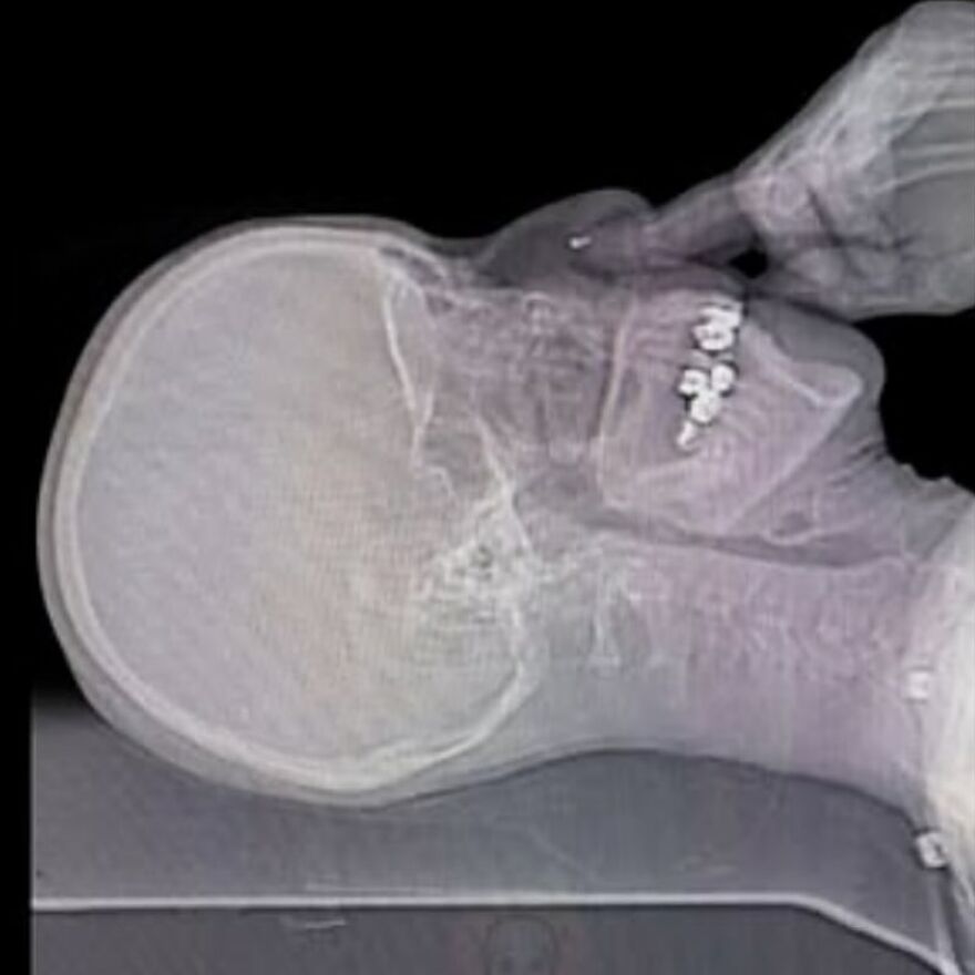 X-ray image showing a side view of a human skull with an unusual object inside the mouth, bizarre medical pic.