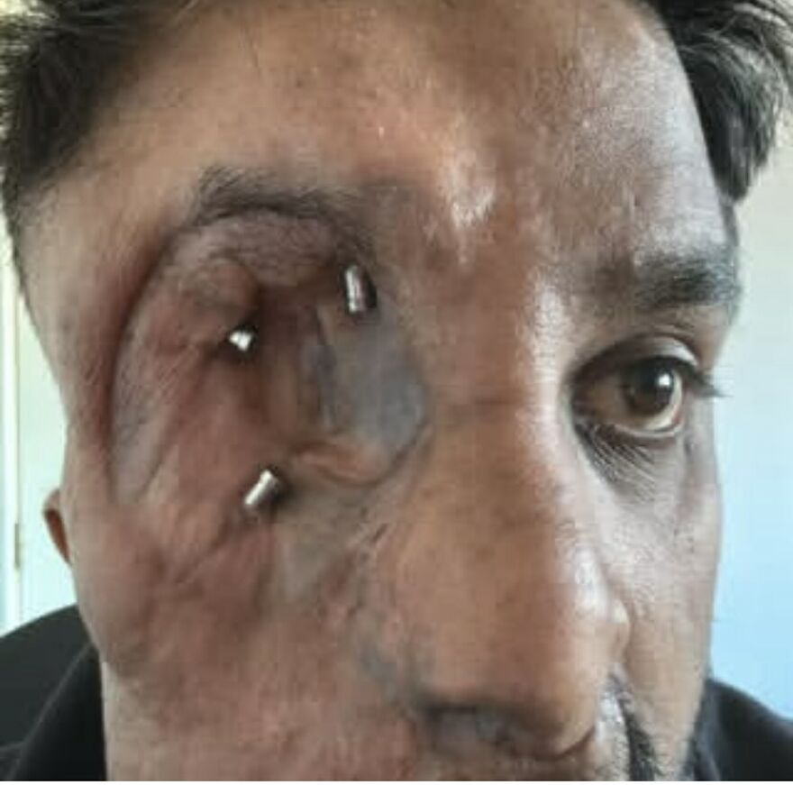 Close-up of a man’s face showing bizarre medical condition with unusual metal implants and distorted skin around the eye area.