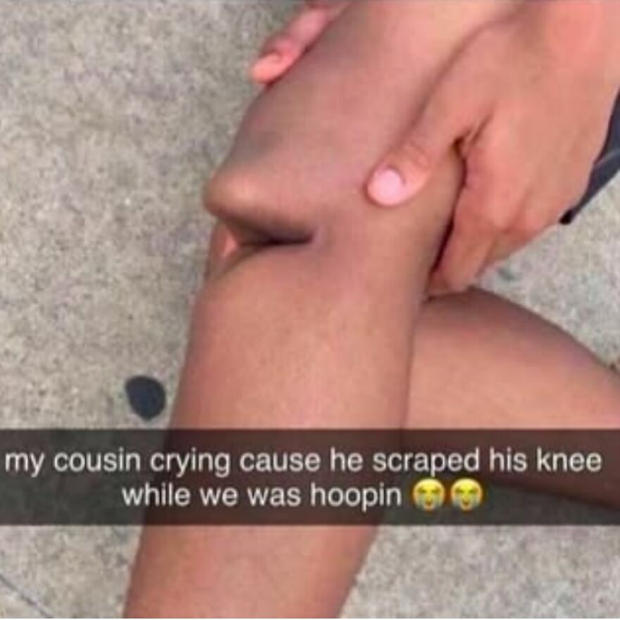 Close-up of a scraped knee with hands holding it, illustrating a bizarre medical pic from an Instagram account.