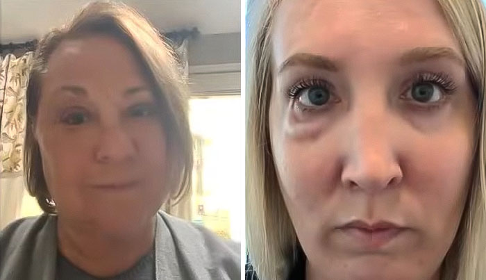 "I Look Worse Than When I Started": Before-And-After Results Of Botched Plastic Surgeries Stun "I Look Worse Than When I Started": Before-And-After Results Of Botched Plastic Surgeries Stun