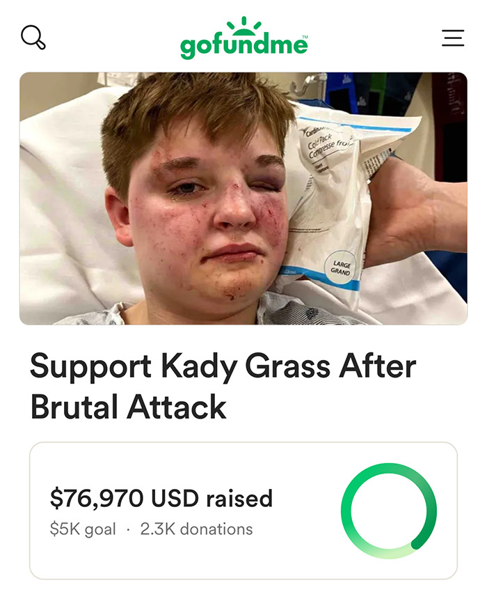 Person with bruised face and black eye in hospital bed, GoFundMe page seeking support after brutal attack on lesbian. Person with bruised face and black eye in hospital bed, GoFundMe page seeking support after brutal attack on lesbian.