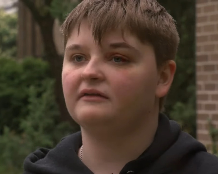 Person with a black eye outdoors, discussing experience as lesbian beaten unconscious for using McDonald's bathroom. Person with a black eye outdoors, discussing experience as lesbian beaten unconscious for using McDonald's bathroom.