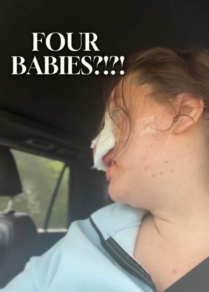 Mom wakes from surgery looking shocked and unprepared after giving birth to multiples in a car seat. Mom wakes from surgery looking shocked and unprepared after giving birth to multiples in a car seat.