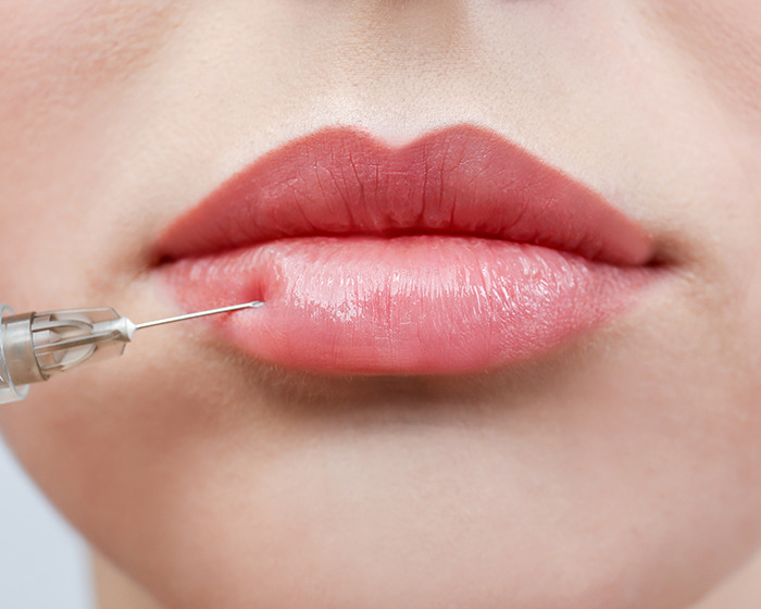 Close-up of a syringe injecting filler into lips illustrating plastic surgeons revealing secrets behind Mar-a-Lago face. Close-up of a syringe injecting filler into lips illustrating plastic surgeons revealing secrets behind Mar-a-Lago face.