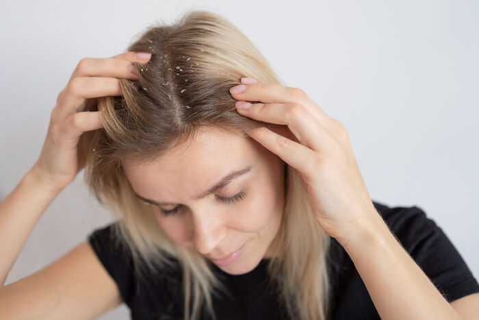 Woman with blonde hair and visible dandruff showing an unkempt public appearance.