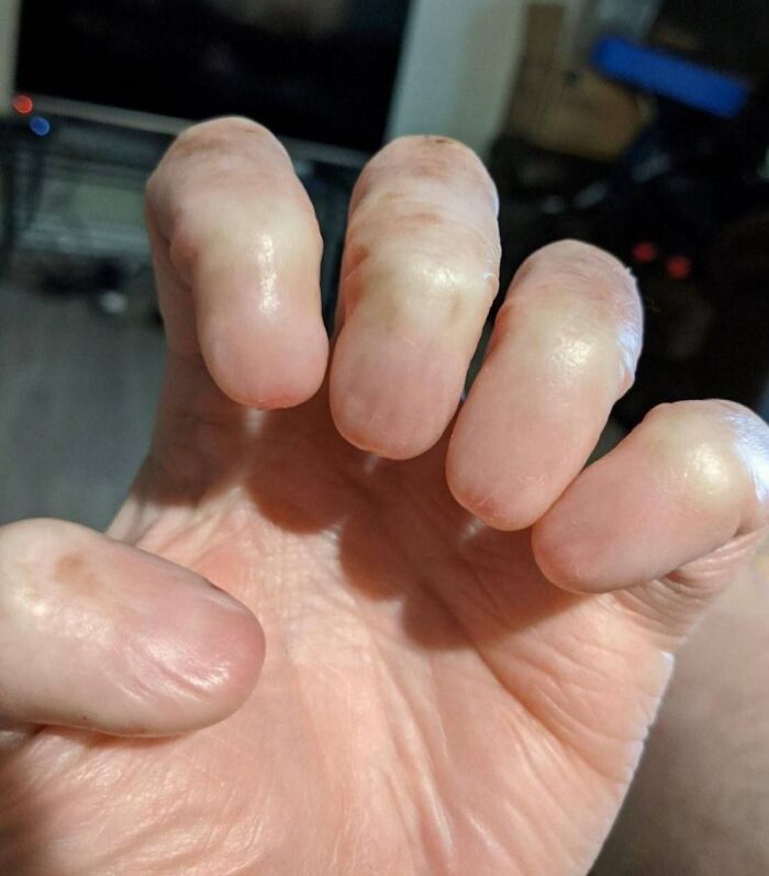 Close-up of human fingers with swollen, smooth skin showing a bizarre and fascinating condition of the human body. Close-up of human fingers with swollen, smooth skin showing a bizarre and fascinating condition of the human body.