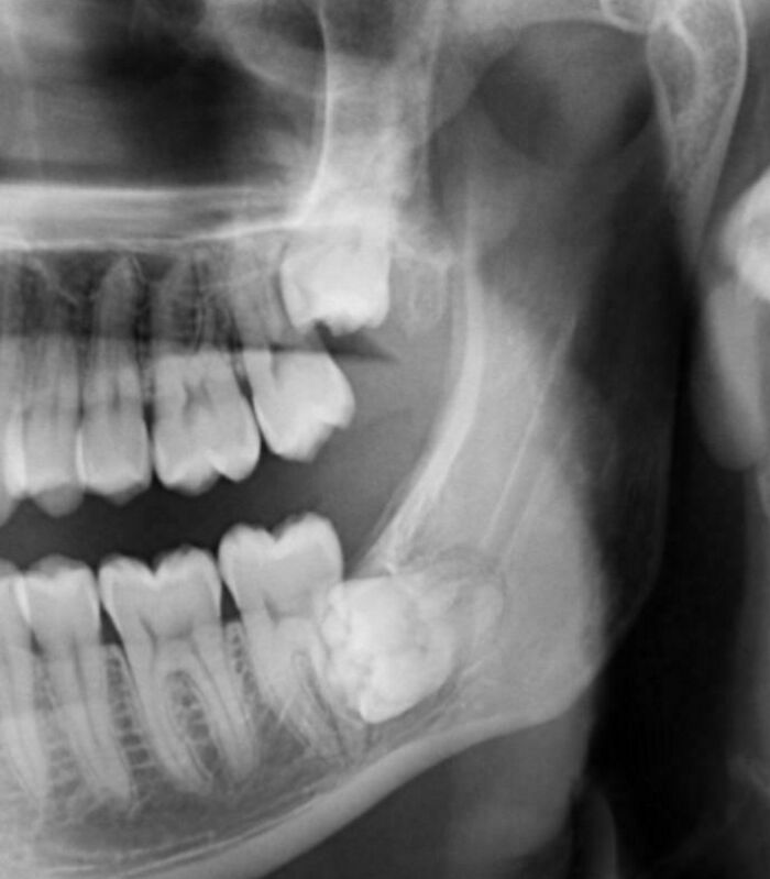 X-ray image showing a human jaw with an impacted wisdom tooth, a bizarre and fascinating human body photo. X-ray image showing a human jaw with an impacted wisdom tooth, a bizarre and fascinating human body photo.