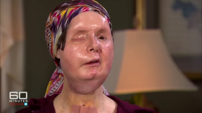 Woman whose face was torn apart by chimpanzee showing her appearance 16 years after face transplant interview setting Woman whose face was torn apart by chimpanzee showing her appearance 16 years after face transplant interview setting