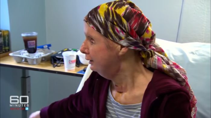 Woman with face transplant 16 years after being attacked by chimpanzee, sitting in a room wearing a colorful headscarf. Woman with face transplant 16 years after being attacked by chimpanzee, sitting in a room wearing a colorful headscarf.