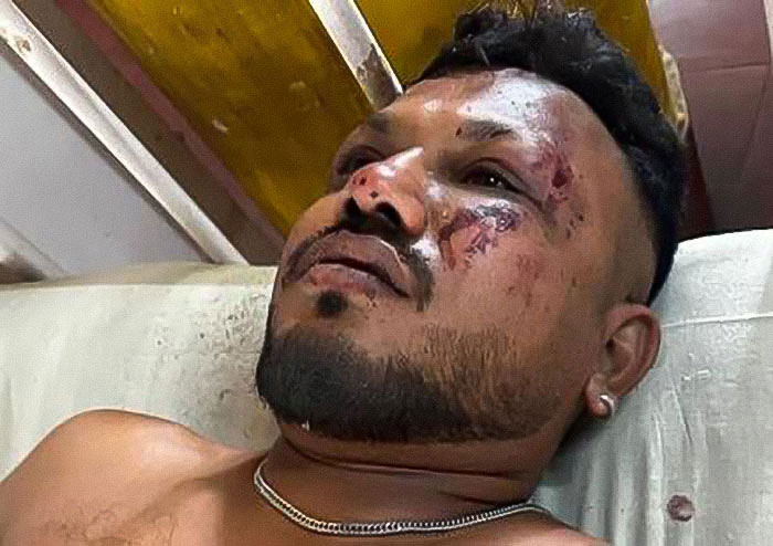 Air India survivor with visible facial injuries lying down, reflecting survivor's guilt and trauma after the incident.