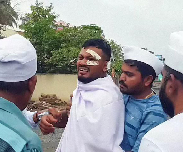 Man with bandages on face, visibly distressed, supported by others outdoors in a moment showing Air India survivor's guilt. Man with bandages on face, visibly distressed, supported by others outdoors in a moment showing Air India survivor's guilt.