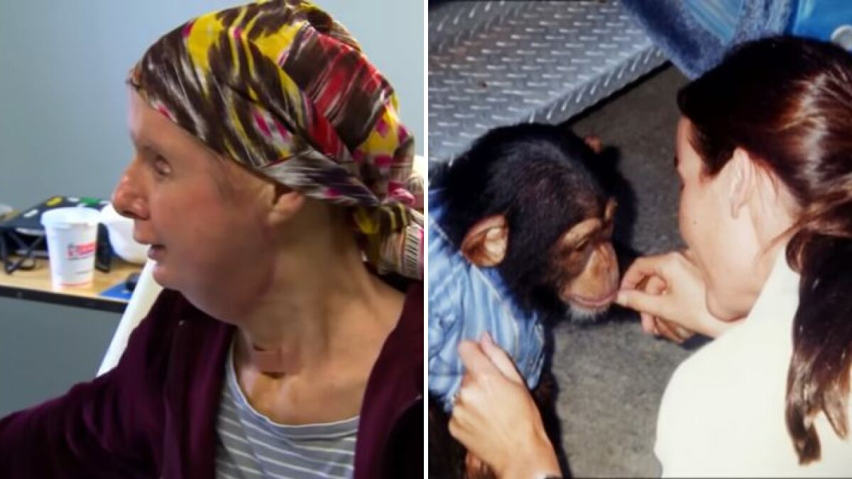 Woman whose face was torn apart by chimpanzee showing appearance 16 years after face transplant in side-by-side photos.