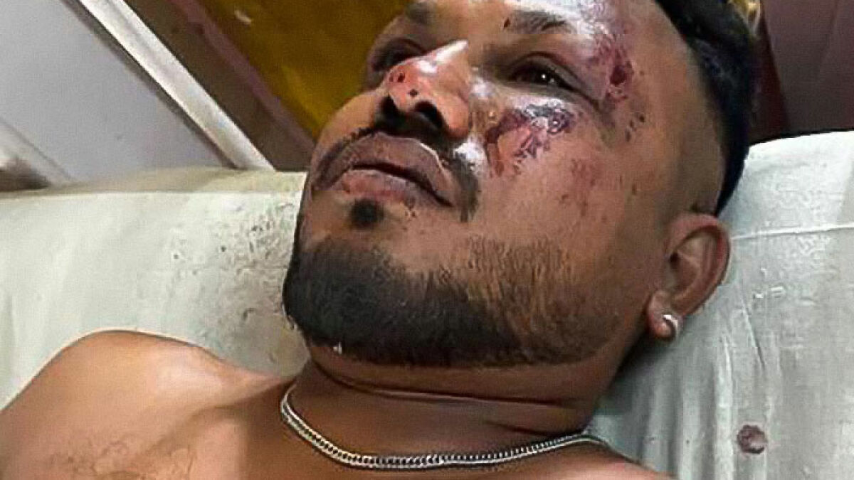 Injured Air India crash miracle survivor lying on a bed with facial wounds and bruises visible.