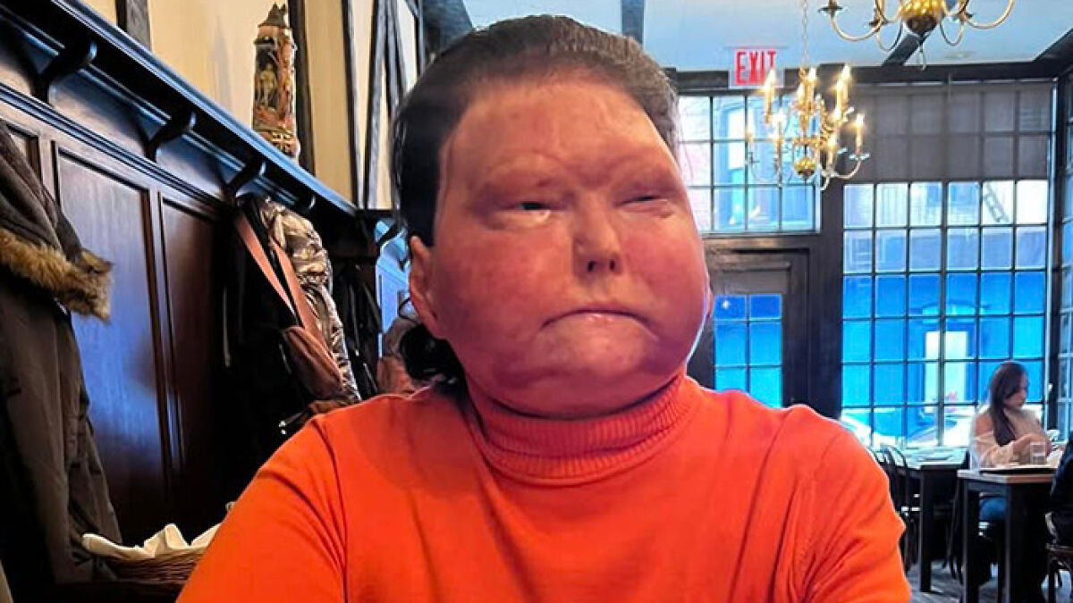Man with a new face transplanted from a 47-year-old donor sitting in a restaurant wearing an orange turtleneck.