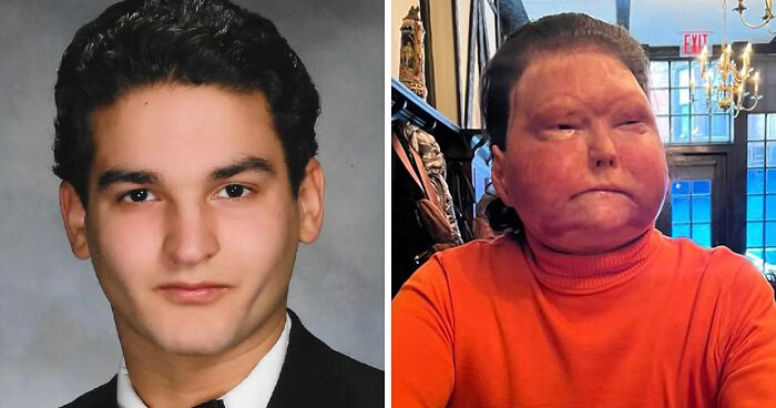 Face And Hand Transplant Recipient Stunned Doctors With What He Felt During Medically Induced Coma