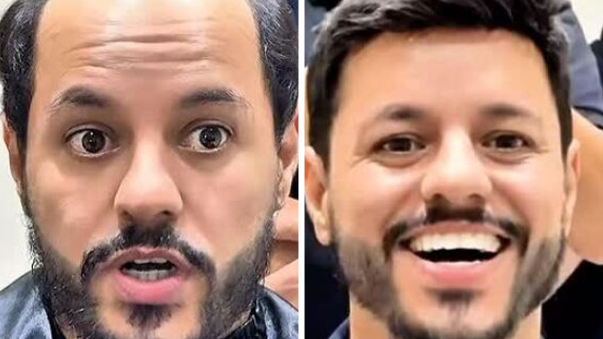Side-by-side images showing a Brazilian stylistu2019s impressive hair restoration results for men with baldness.