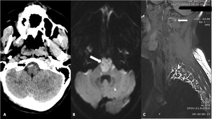CT and MRI scans showing brainstem and cervical spine areas linked to neck pain and locked-in syndrome after chiropractic visit. CT and MRI scans showing brainstem and cervical spine areas linked to neck pain and locked-in syndrome after chiropractic visit.