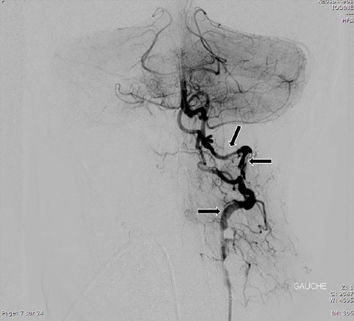 X-ray image of blood vessels in the neck highlighting issues related to chiropractor neck pain and locked-in syndrome. X-ray image of blood vessels in the neck highlighting issues related to chiropractor neck pain and locked-in syndrome.