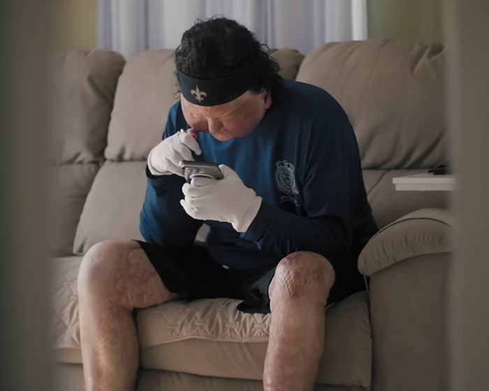 Man who got a new face transplanted from 47-year-old donor sitting on couch using smartphone wearing white gloves. Man who got a new face transplanted from 47-year-old donor sitting on couch using smartphone wearing white gloves.