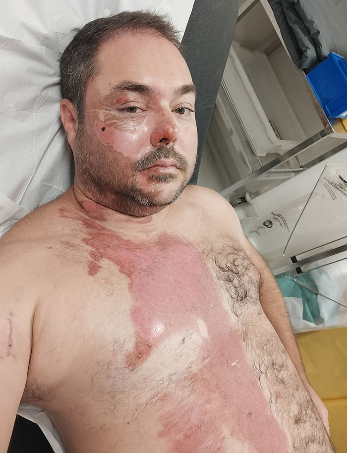 Man with severe burn injuries on face and chest lying on hospital bed after domestic violence incident. Man with severe burn injuries on face and chest lying on hospital bed after domestic violence incident.