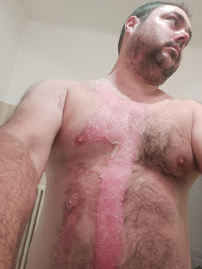 Man with large scald burn injuries on chest and torso, highlighting domestic violence and hospitalization from abuse. Man with large scald burn injuries on chest and torso, highlighting domestic violence and hospitalization from abuse.