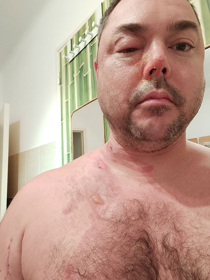Man showing severe facial and chest burns after domestic violence incident in a landmark case against ex-girlfriend. Man showing severe facial and chest burns after domestic violence incident in a landmark case against ex-girlfriend.