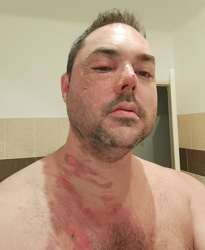 Man with visible scald burns and injuries on face and neck related to landmark domestic violence case against ex-girlfriend. Man with visible scald burns and injuries on face and neck related to landmark domestic violence case against ex-girlfriend.