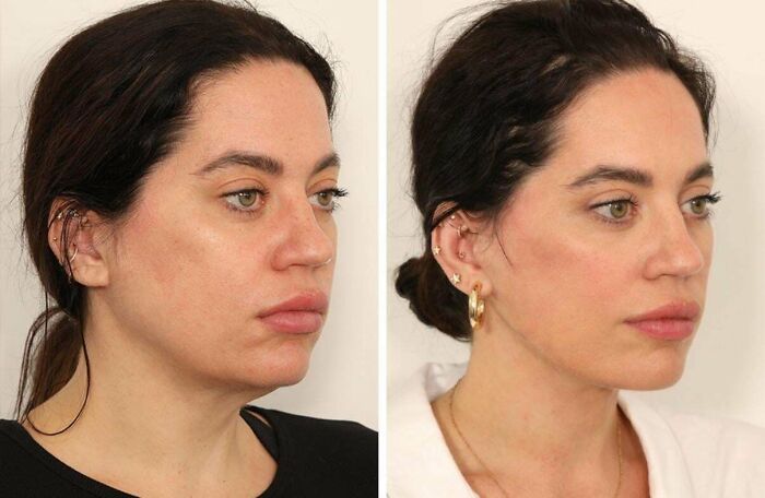 Side-by-side before and after plastic surgery photos showing a woman’s facial transformation and enhanced contour.