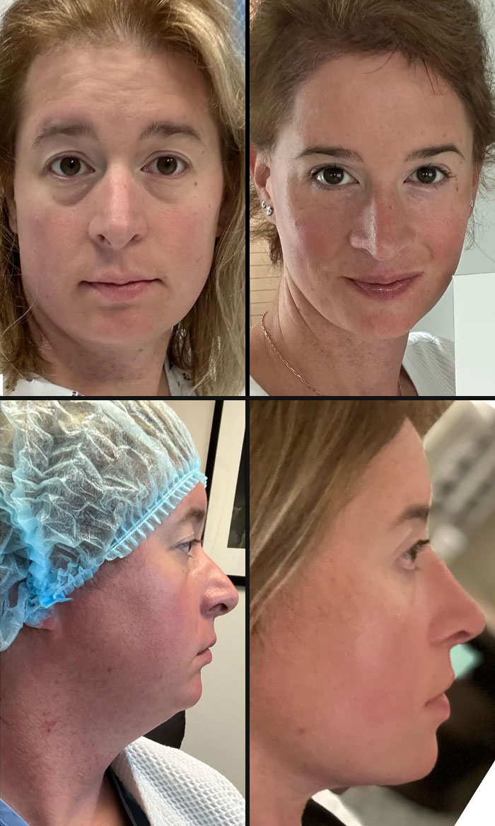Before and after plastic surgery photos showing facial transformation of a woman from Costco mom to Beverly Hills housewife.
