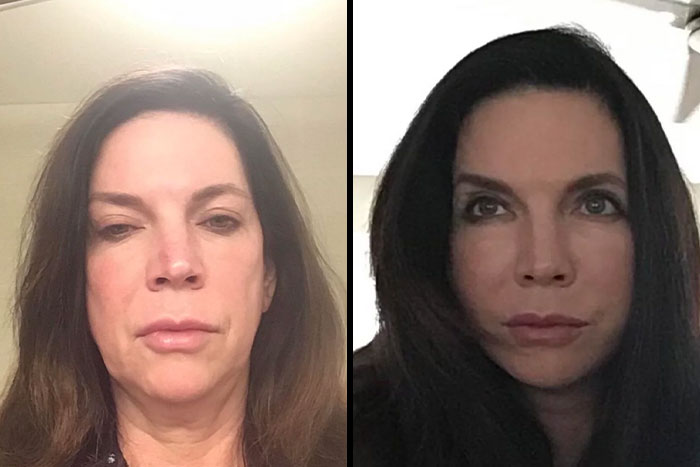 Before and after plastic surgery comparison of a woman showcasing dramatic facial transformation and cosmetic enhancements.