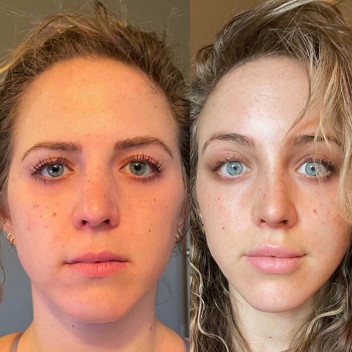 Before and after plastic surgery comparison of a woman showing transformation in facial features and skin tone.