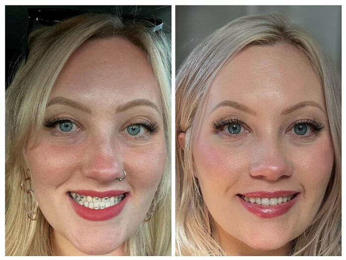 Side-by-side before and after plastic surgery photos of a woman showing facial transformation results