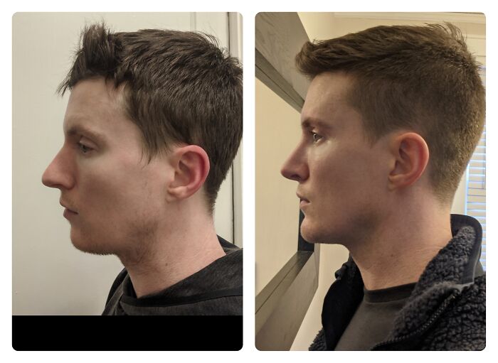 Side-by-side profile comparison showing a young man before and after plastic surgery transformation, highlighting facial contour changes.