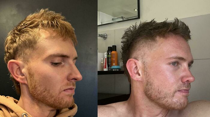 Side-by-side before and after plastic surgery photos showing facial transformation for Beverly Hills housewife look.