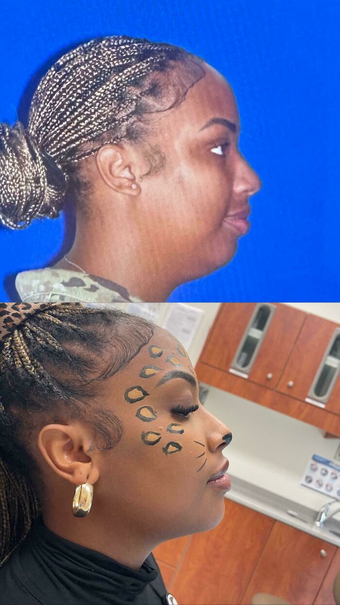 Side-by-side before and after plastic surgery photos showing facial transformation of a woman with braided hair.