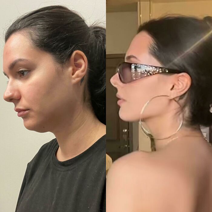 Side-by-side before and after plastic surgery photos showing a woman’s transformation into a Beverly Hills housewife look