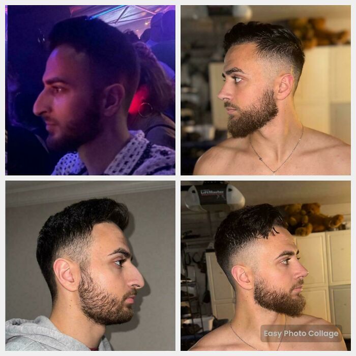 Before and after plastic surgery photos showing facial transformation with improved profile and beard style for SEO plastic surgery keywords.