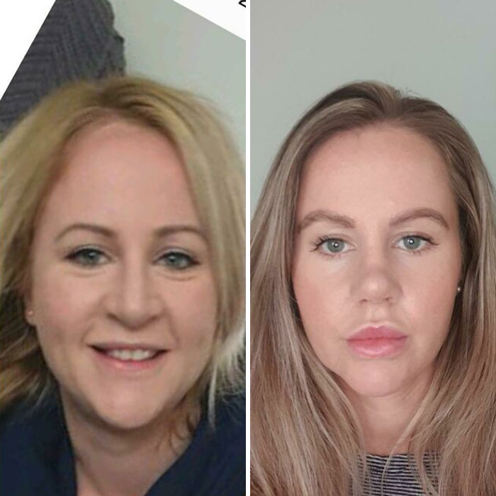 Before and after plastic surgery transformation showing a woman’s facial changes from mom at Costco to Beverly Hills housewife.