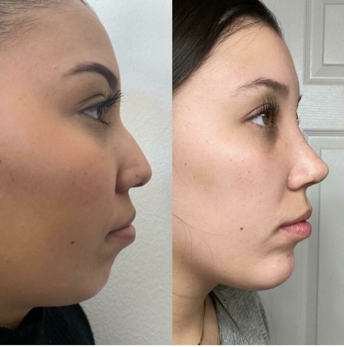 Side-by-side before and after plastic surgery photos showing facial transformation from mom to Beverly Hills housewife look