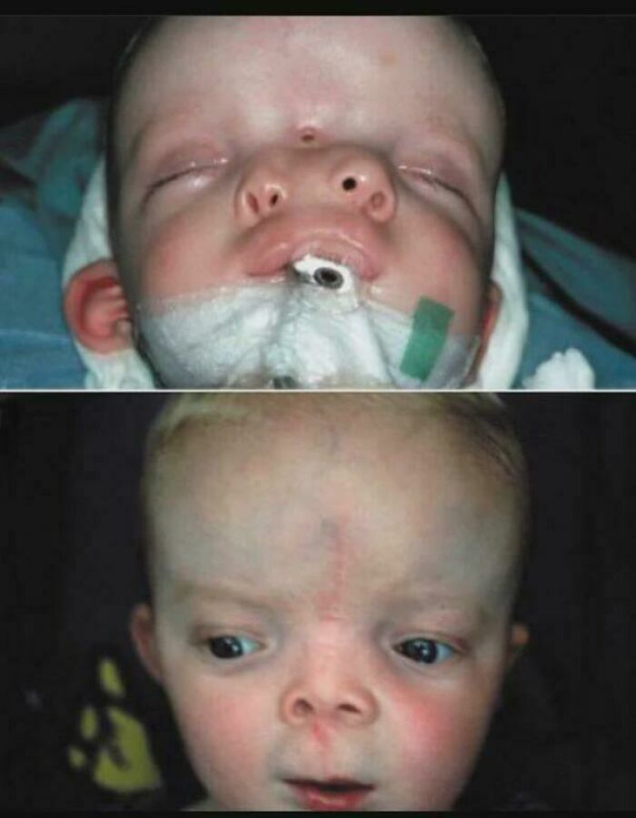 Infant with throat tube and facial scar in before and after view, medical pics