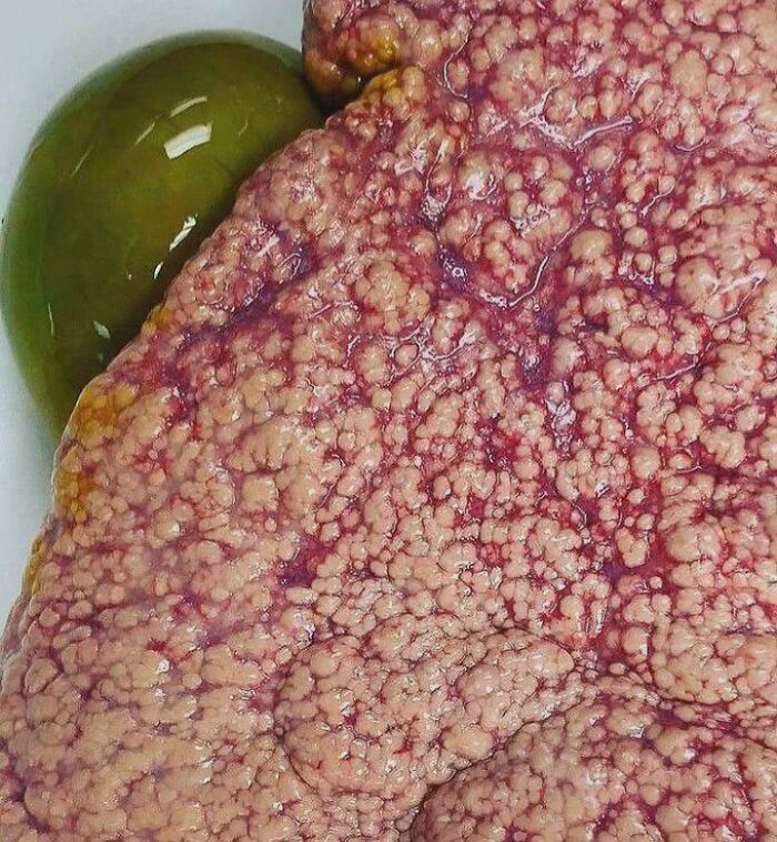 Close-up of nodular diseased liver surface with adjacent green gallbladder, medical pics