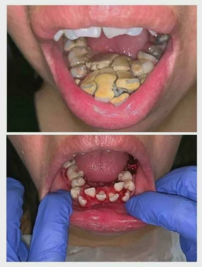 Two medical pics showing severe dental calculus buildup and lower tooth extractions with bloody gums and gloved hands.