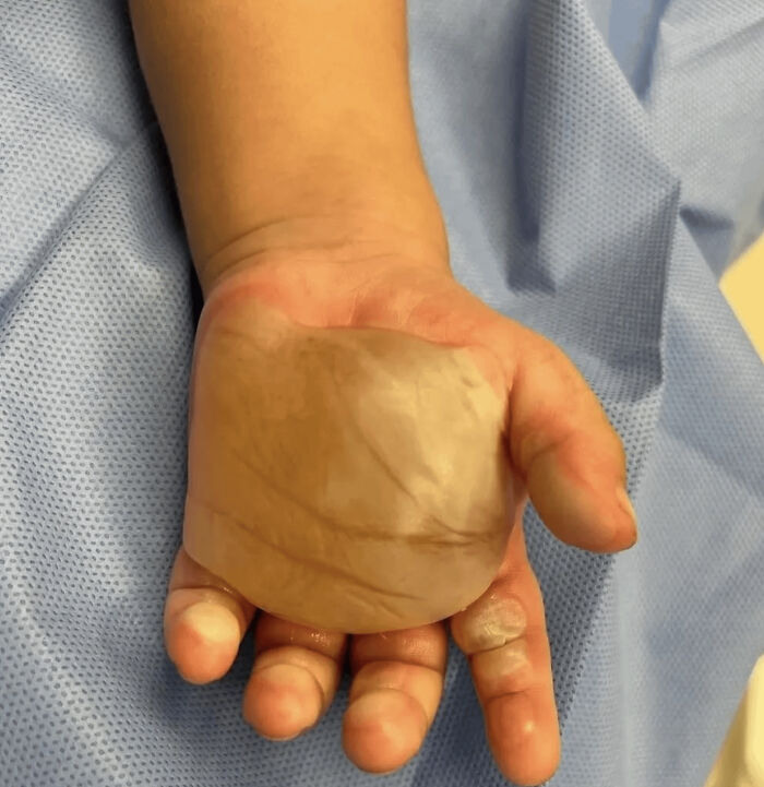 Close-up of a child's hand showing a large translucent palm blister and swollen fingers, medical pics