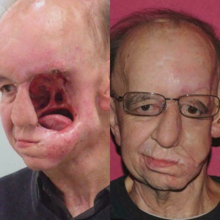 Before and after facial reconstruction of man with severe cheek and eye loss, medical pics
