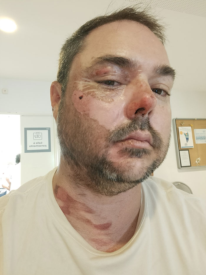 Man with visible burn scars on face and neck in a clinical setting following landmark domestic violence case. Man with visible burn scars on face and neck in a clinical setting following landmark domestic violence case.
