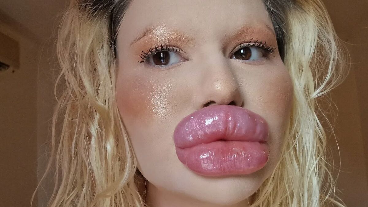 Close-up of woman with world's biggest lips showing extreme lip enhancement after costly surgeries.