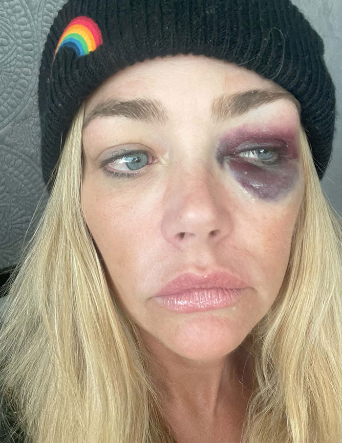 Denise Richards wearing a black beanie with a rainbow, showing a severe black eye from alleged assault by estranged husband. Denise Richards wearing a black beanie with a rainbow, showing a severe black eye from alleged assault by estranged husband.