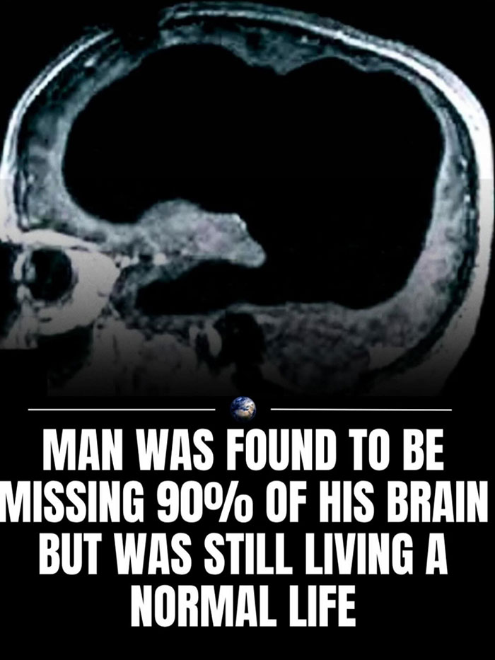 MRI scan showing a brain with 90 percent missing, highlighting a man living a normal life despite the condition. MRI scan showing a brain with 90 percent missing, highlighting a man living a normal life despite the condition.